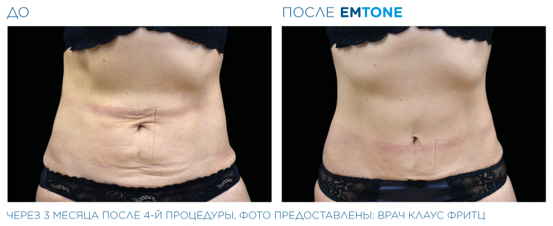 emtone_pic_ba-card-female-abdomen-023_ru100.png-800x327.png emtone_pic_ba-card-female-abdomen-023_ru100.png-800x327.png