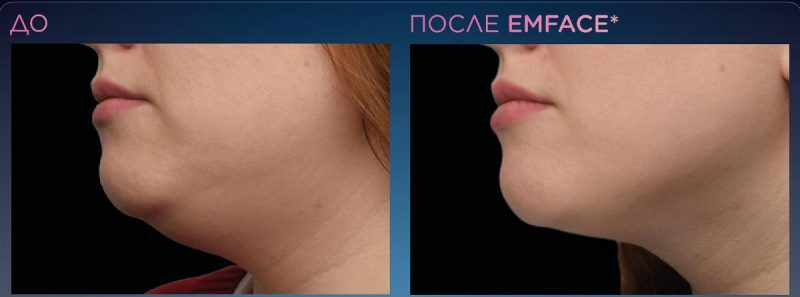 emface_ppt_submentum-product-presentat8-800x297.jpg emface_ppt_submentum-product-presentat8-800x297.jpg