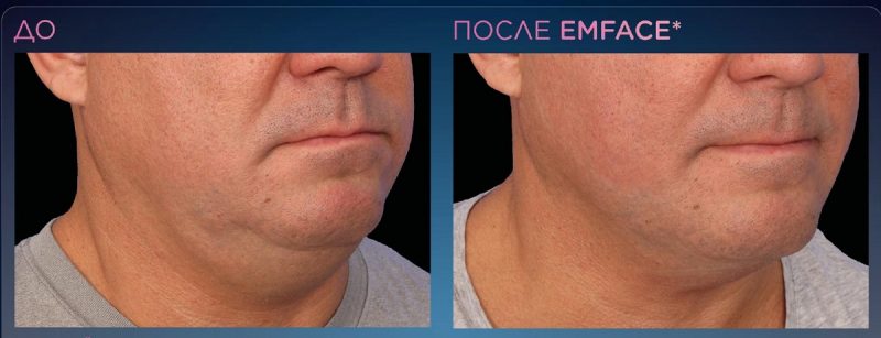 emface_ppt_submentum-product-presentation_ru100-3-800x307.jpg emface_ppt_submentum-product-presentation_ru100-3-800x307.jpg